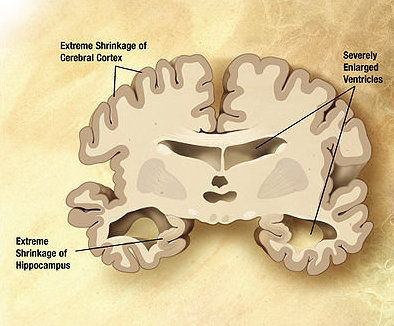 Кората на засегнатия от Алцхаймер мозък постепенно се свива, хипоталамусът намалява, а кухините растат Снимка:  Wikimedia, CC